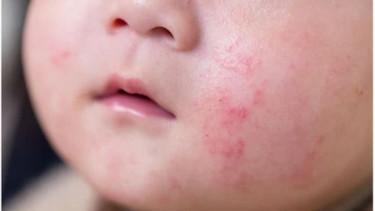 Phát ban sau sốt mọc răng có sao không? Cách chăm sóc trẻ bị phát ban