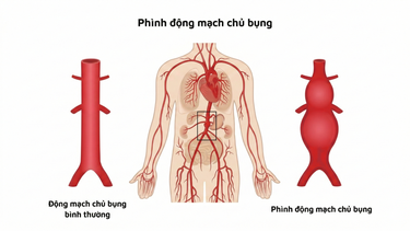 Phình động mạch chủ bụng là gì? Nguyên nhân, triệu chứng và cách phòng ngừa