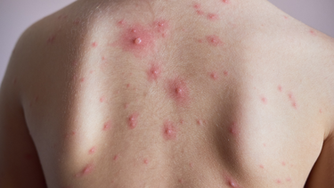 Phỏng dạ là gì? Nguyên nhân, triệu chứng và điều trị