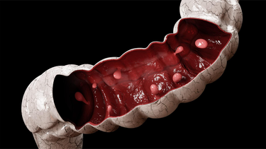 Polyp đại tràng là gì? Triệu chứng, nguyên nhân, chẩn đoán và phương pháp điều trị