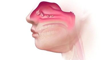 Polyp mũi ở trẻ em: Những điều cha mẹ cần biết để bảo vệ sức khỏe hô hấp cho bé