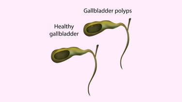 Polyp túi mật 7mm có nguy hiểm không? Hướng dẫn theo dõi và xử trí