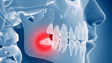 Răng khôn mọc lệch: Những điều bạn cần biết