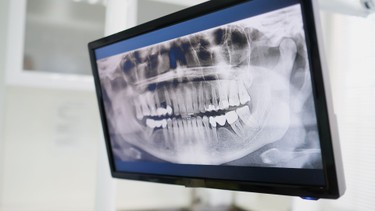 Răng ngắn: Nguyên nhân, cách nhận biết và phương pháp điều trị hiệu quả