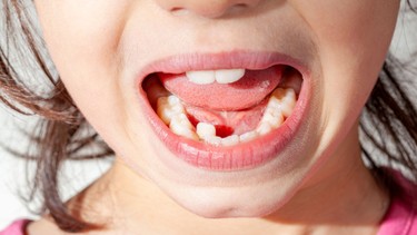 Răng sữa chưa rụng đã mọc răng mới: Xử lý sao để không lệch hàm?