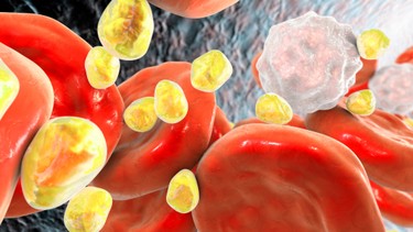 Rối loạn chuyển hóa lipid: Dấu hiệu, nguy cơ và cách kiểm soát hiệu quả