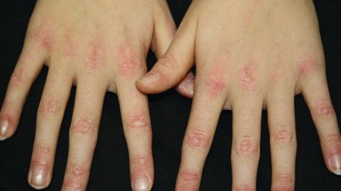 Sẩn gottron là gì? Triệu chứng và nguyên nhân gây bệnh