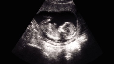 Siêu âm 2D thai là gì? Những đặc điểm của siêu âm 2D mẹ bầu nên biết 