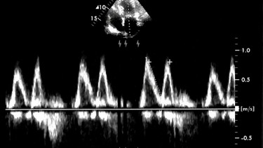 Siêu âm Doppler tim: Lợi ích, quy trình và những điều bệnh nhân cần biết