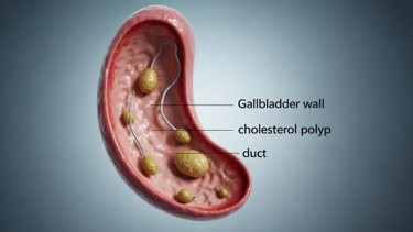 Vai trò của siêu âm ổ bụng polyp túi mật và phương pháp xử trí
