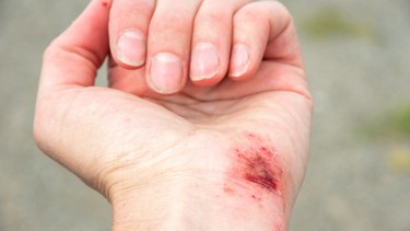 Sơ cứu vết thương ngoài da: Cách xử lý đúng và an toàn cho người bệnh