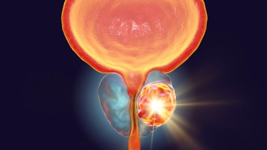 Sỏi tuyến tiền liệt là gì? Những điều cần biết về sỏi tuyến tiền liệt