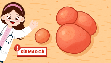 Sùi mào gà: Lầm tưởng nhỏ - Hậu quả lớn