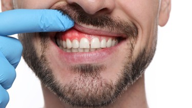 Sưng nướu răng có tự hết không? Khi nào cần gặp bác sĩ?