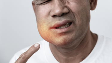 Sưng tuyến nước bọt là gì? Triệu chứng, nguyên nhân và phương pháp điều trị