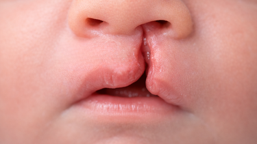 Sứt môi 4mm là gì? Có nguy hiểm không và cần xử lý thế nào?