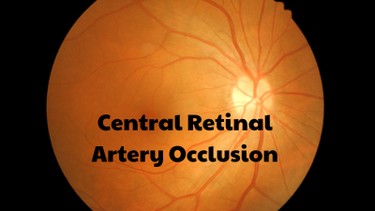 Tắc động mạch trung tâm võng mạc là tình trạng thế nào? Nguyên nhân và cách điều trị