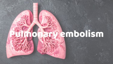 Tắc nghẽn mạch phổi: Nguyên nhân, triệu chứng và biện pháp phòng ngừa