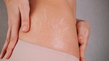 Tại sao bị rạn da ở tuổi dậy thì? Cách phòng ngừa rạn da đơn giản bạn nên biết