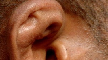 Tai súp lơ là gì? Nguyên nhân, dấu hiệu và những thông tin cần biết