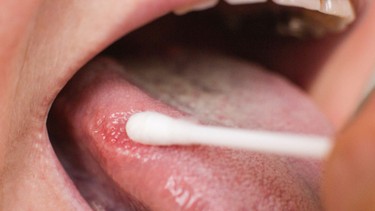 Tay chân miệng ở lưỡi: Dấu hiệu nhận biết và cách chăm sóc an toàn cho trẻ