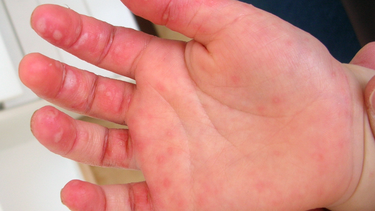 Chủng virus EV71 có gây ảnh hưởng tới hệ thần kinh ở trẻ nhỏ mắc tay chân miệng