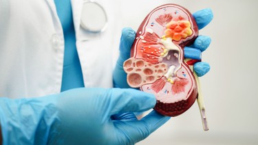 Thận ứ nước độ 4: Mức độ nguy hiểm và khả năng điều trị