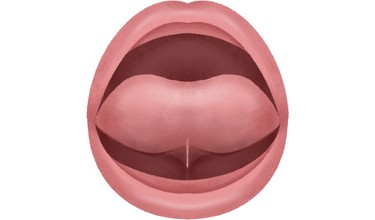 Trẻ bị dính thắng lưỡi có nói được không? Cha mẹ cần phải làm gì?