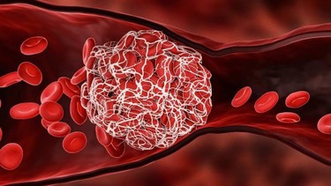 Thiếu máu cơ tim cục bộ nên ăn gì để bảo vệ sức khỏe tim mạch?