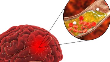 Thiếu oxy lên não ăn gì để hỗ trợ cải thiện tuần hoàn và chức năng não?