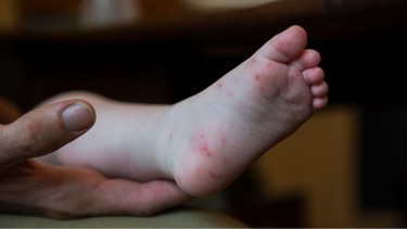 Thời tiết nóng làm tăng nguy cơ mắc bệnh tay chân miệng