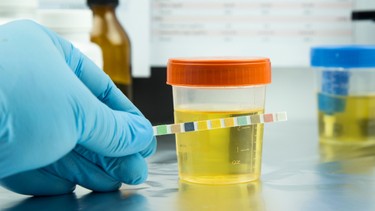 Xét nghiệm nước tiểu có biết bị tiểu đường không? Khi nào nên thực hiện?