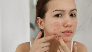 Thức khuya có nổi mụn không​? Biện pháp cải thiện tình trạng da mụn