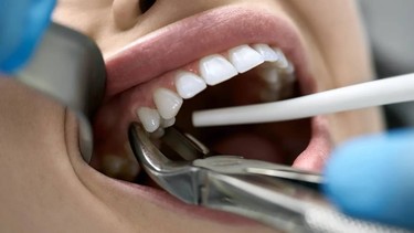 Thuốc tê nhổ răng có ảnh hưởng đến thai nhi không? 