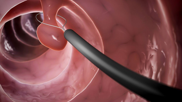 Tìm hiểu nội soi cắt polyp đại tràng và những lưu ý quan trọng