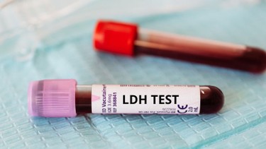 Tìm hiểu về xét nghiệm LDH: Thông tin cần biết trước khi thực hiện