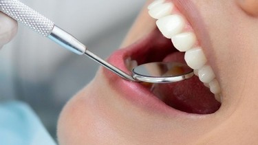 Viêm chân răng có mủ: Nguyên nhân, dấu hiệu và cách điều trị hiệu quả