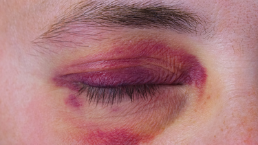 Top 7 cách làm tan vết bầm tím ở mắt nhanh, an toàn và hiệu quả tại nhà