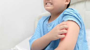 Nổi mề đay kiêng gì? Những điều cần tránh để kiểm soát bệnh hiệu quả