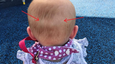 Trẻ sơ sinh bị lõm đầu phía sau có sao không? Cách khắc phục hiệu quả