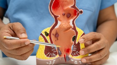 Trĩ huyết khối là gì? Dấu hiệu nhận biết và phương pháp điều trị hiệu quả