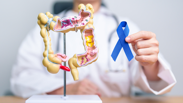 Triệu chứng của polyp đại tràng ác tính là gì? Khi nào nên tầm soát polyp đại tràng?