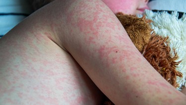 Triệu chứng sốt siêu vi phát ban và cách điều trị hiệu quả