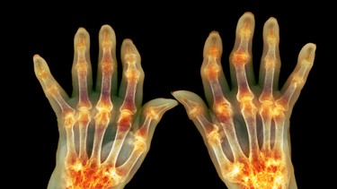Triệu chứng viêm khớp dạng thấp: Nhận biết sớm để tránh biến chứng nặng