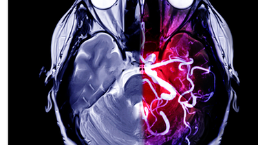 Triệu chứng xuất huyết não nhẹ: Dấu hiệu cảnh báo sớm không nên bỏ qua