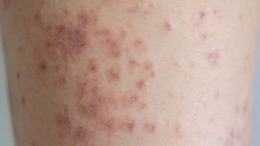 Tử ban não mô cầu: Dấu hiệu nhận biết sớm và cách phòng ngừa hiệu quả