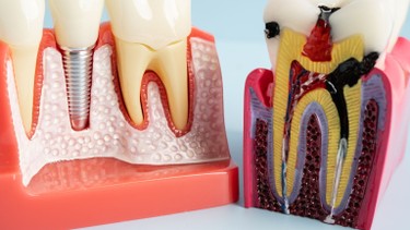 Tuổi thọ răng lấy tủy là bao lâu? Các yếu tố ảnh hưởng đến tuổi thọ răng sau lấy tủy