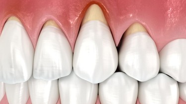 Tụt lợi có nguy hiểm không? Cách chăm sóc và điều trị hiệu quả