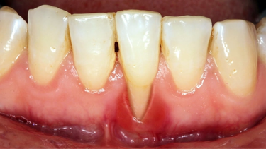 Tụt lợi có tự khỏi không? Những cách khắc phục hiệu quả