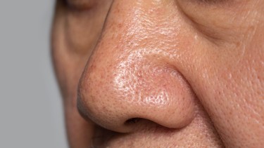 Tuyến bã nhờn là gì? Vai trò của tuyến bã nhờn đối với làn da và mái tóc